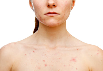 acne skin health acneic