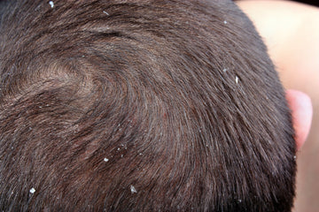 scalp inflammation diet foods