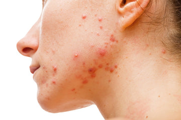 Harnessing the Power of Omega-3: Natural Supplements for Acne Relief