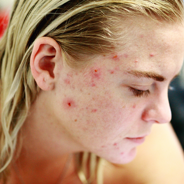Oil Masks Detoxify Acne Prone Skin Naturally pollution pores Black Cumin Seed Nigella sativa antibacterial anti-inflammatory antioxidant soothe redness calm breakouts