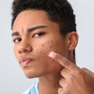 Vitamin B Acne Clearer Skin blemish-free Hormonal Fluctuations Bacterial Overgrowth Dietary B3 B5 B6 stinging nettle chickweed carrot gotu kola