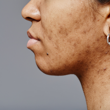 Natural Spot Treatments Oils Balms breakout traditional acne inflamed skin Propolis Bee Based Healing antimicrobial anti-inflammatory pimples blemishes bacteria reduces swelling redness Tea Tree Antiseptic Calendula Soothing Healer