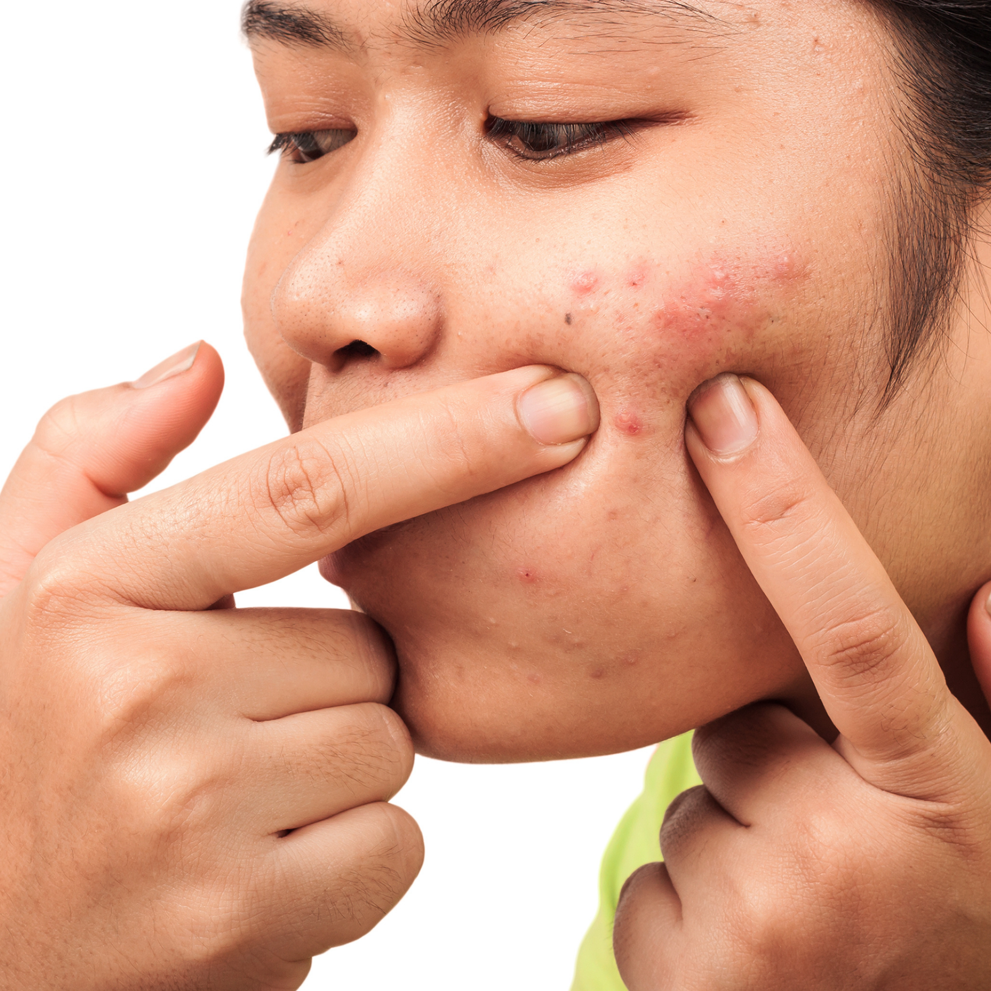 Hormonal Acne Power Seed Oils skin jawline chin cheeks menopause stress inflamed treatments gentle remedies balancing inflammation Black Cumin antibacterial complexion redness swelling Rosehip regeneration Pumpkin