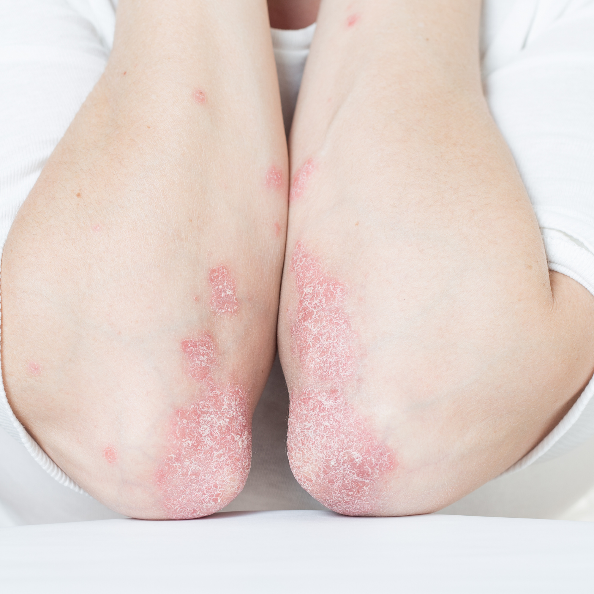 Can Milk Thistle Help with Eczema and Psoriasis?